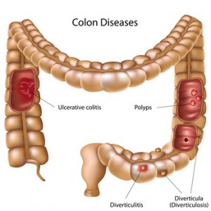 Cómo Comprender los Pólipos del colon y su Tratamiento – Dr. Sergio Cázares